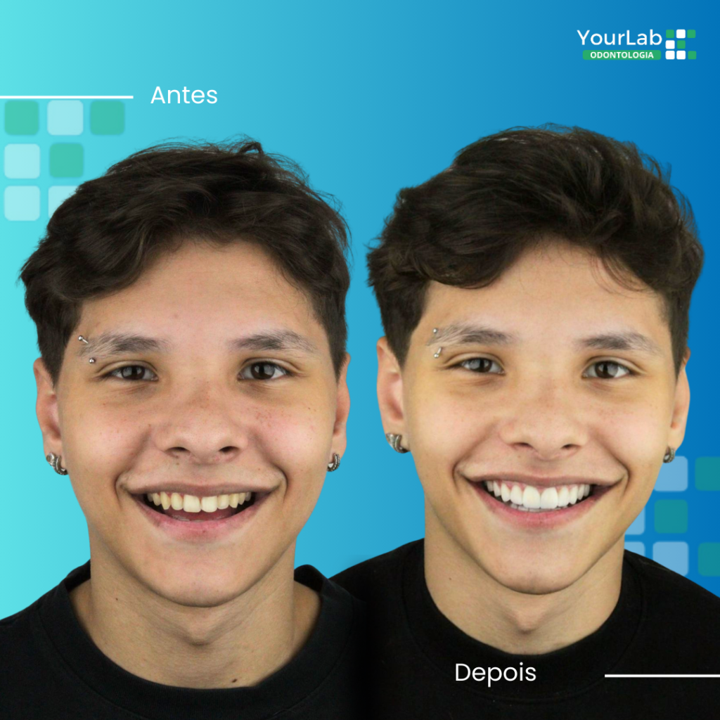 antes e depois odontologia | YourMed