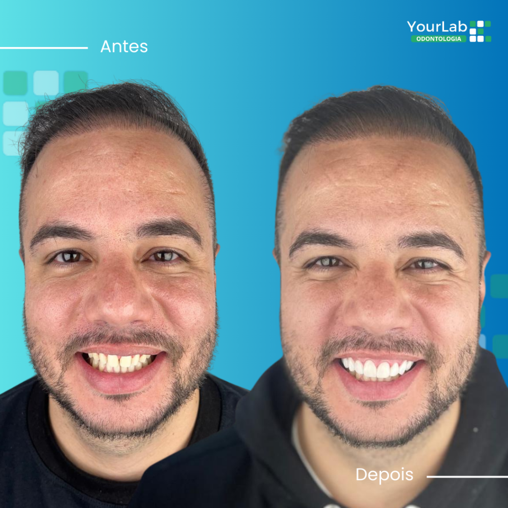 antes e depois odontologia 3 - imagem 2 | YourMed