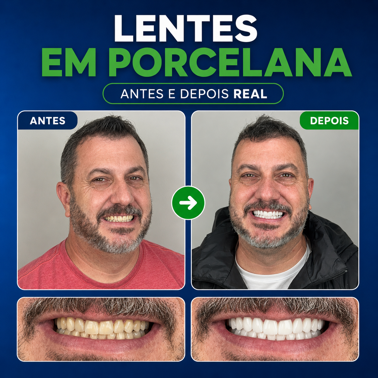 Antes e depois real de lentes em porcelana YourMed com dentes mais brancos e sorriso renovado