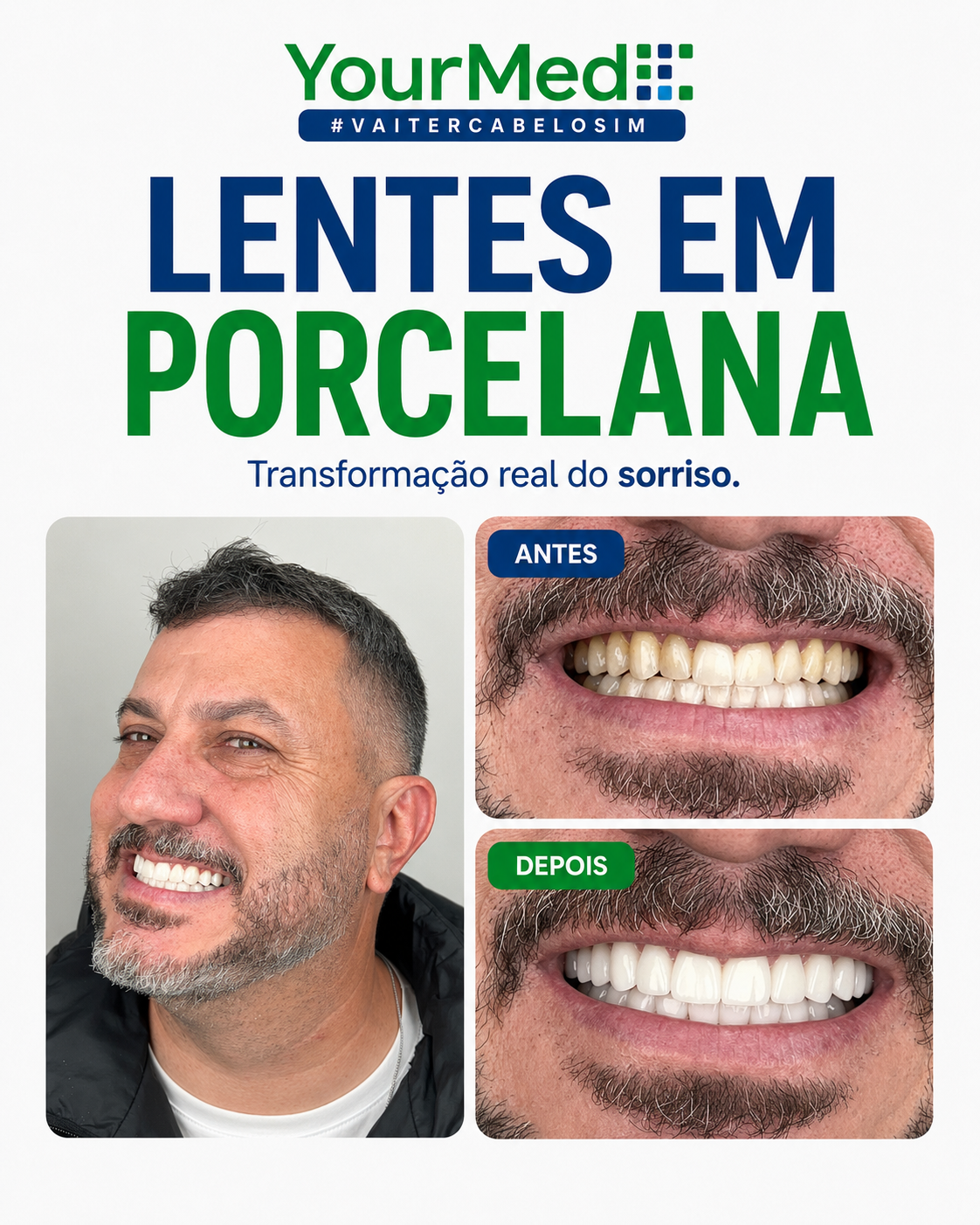Transformação de sorriso com lentes em porcelana YourMed em antes e depois