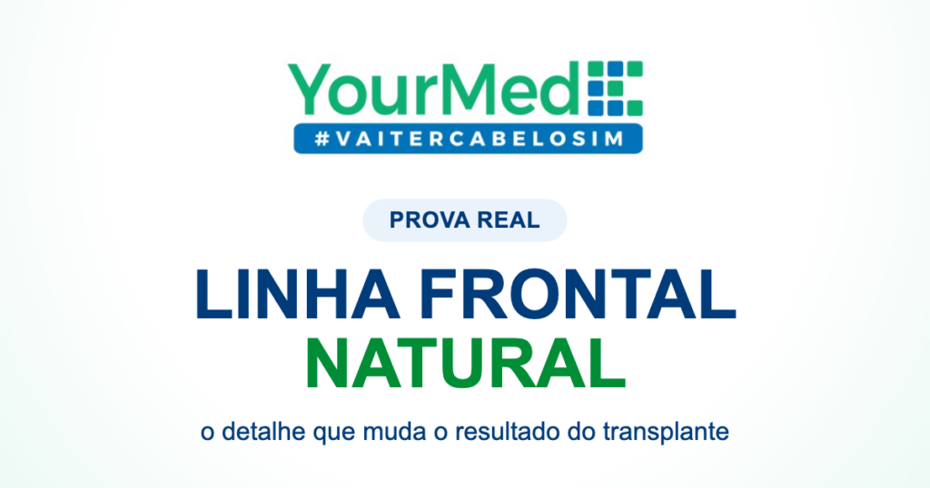 Linha frontal natural no transplante capilar: o que observar antes de decidir | YourMed VaiTerCabeloSim