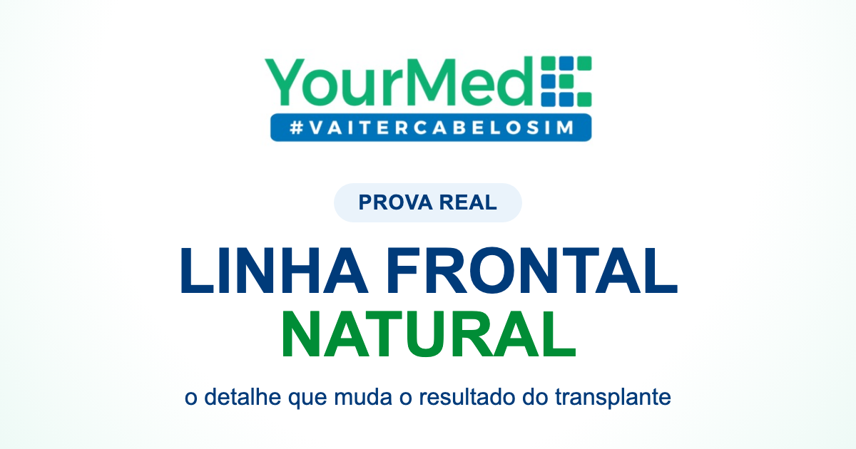 Linha frontal natural no transplante capilar: o que observar antes de decidir | YourMed VaiTerCabeloSim