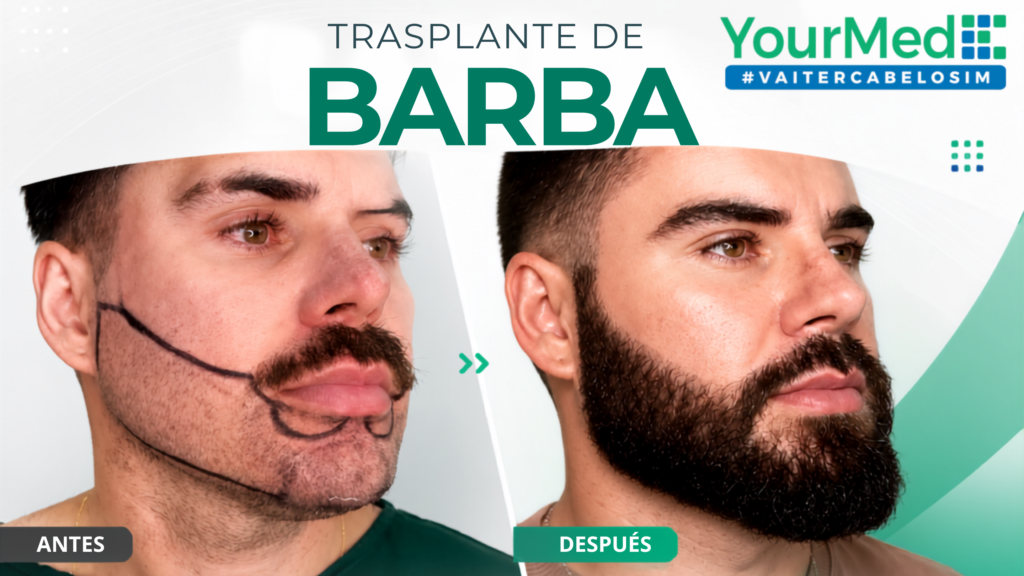 Antes y después de trasplante de barba en YourMed Chile